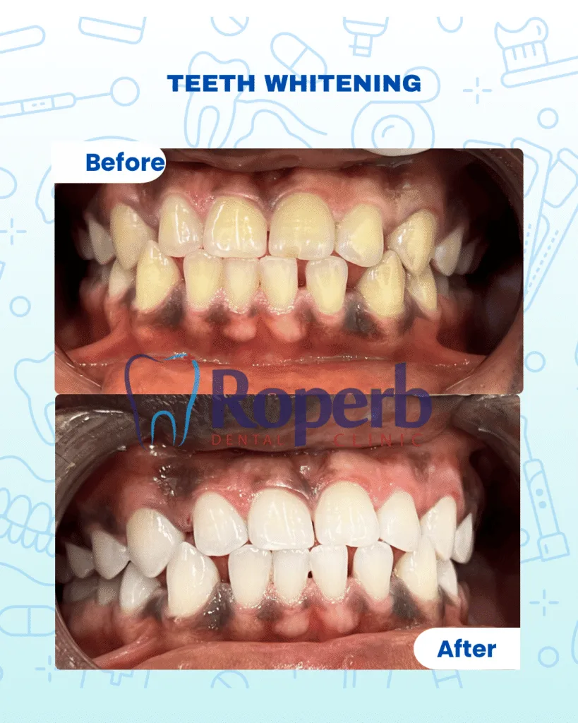 Teeth whitening