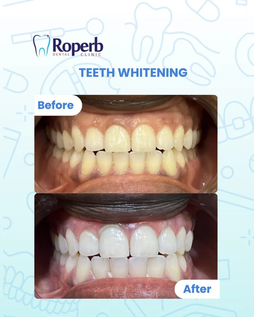 Teeth whitening