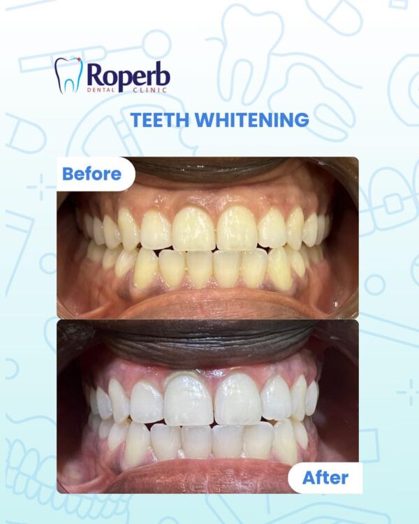 Teeth whitening