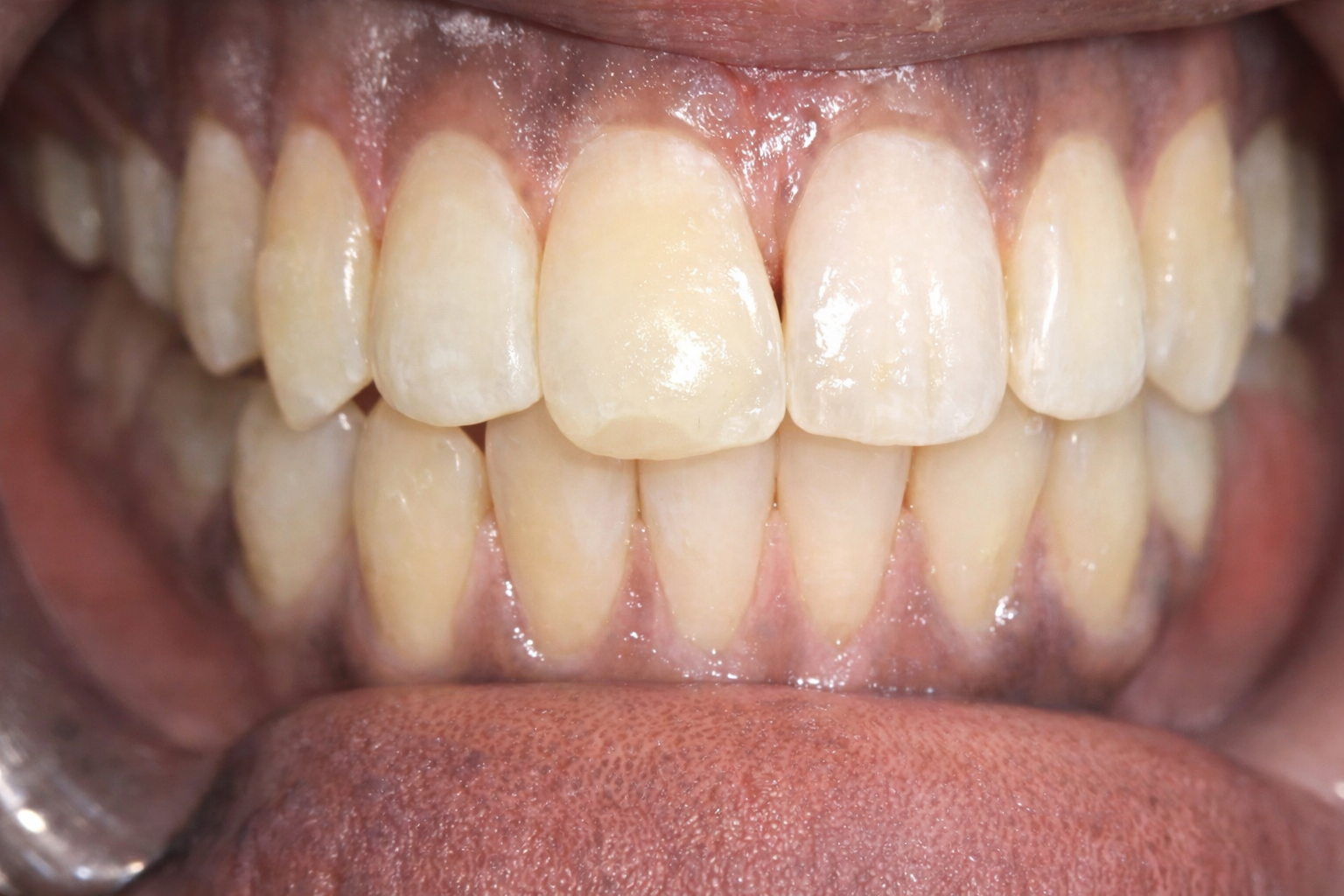 After Treatment