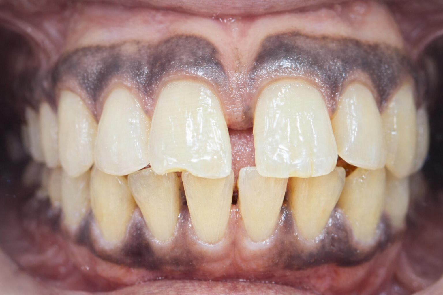 Before Treatment