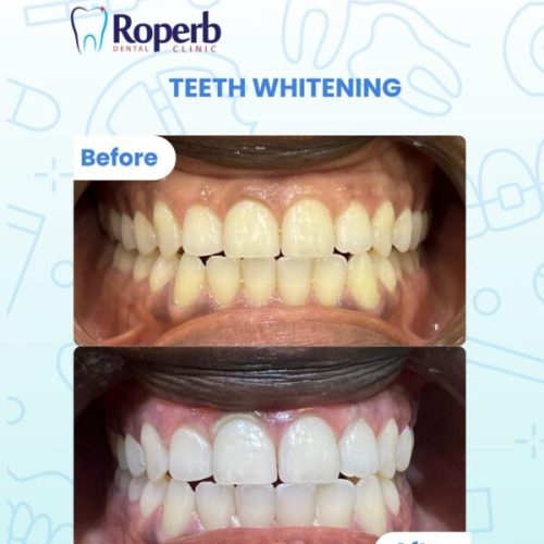 Teeth whitening